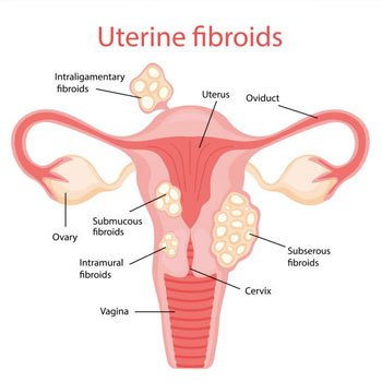 Fibroid Treatment Hospital Samstipur