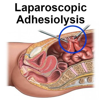Adhesiolysis treatment in Krishna Hospital