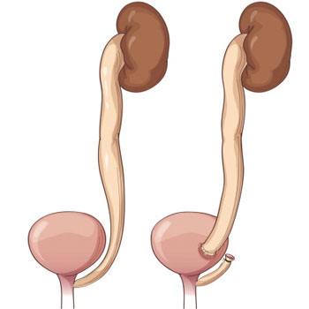 Ureteric Reimplantation treatment in Krishna Hospital