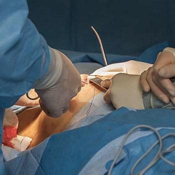 Breast Surgery in Krishna Hospital Samastipur