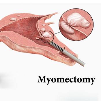 Remove Fibroid treatment in Krishna Hospital